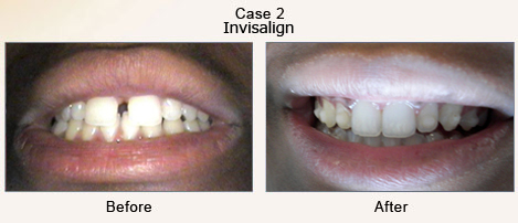 Case 2 – Invisalign