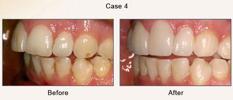 Case 4 – Smile Makeover