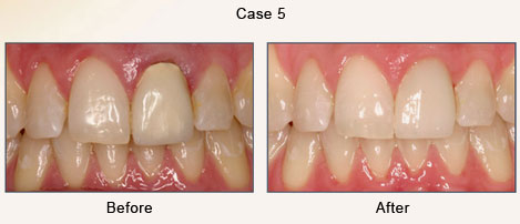 Case 5 – Cosmetic Restoration