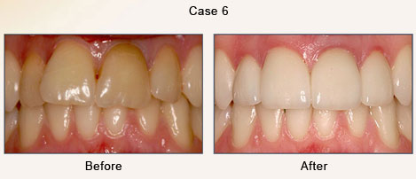 Case 6 – Smile Transformation